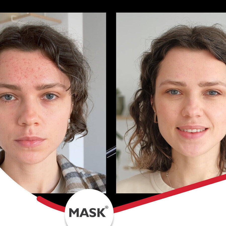 Mask Plus Acne Gel, 30 ml, Solartium - Trattamento efficace e diretto sulla tua pelle